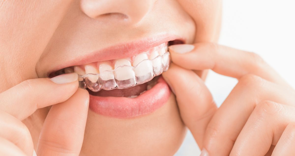 Clear Dental Aligner in India – Embracing the Future of Orthodontics
